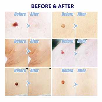 Gambar produk LEKGAVD Alat Penghilang Kutil Painless Skin Tag Mole Removal Kit - LGV40 - 3