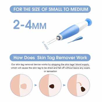 Gambar produk LEKGAVD Alat Penghilang Kutil Painless Skin Tag Mole Removal Kit - LGV40 - 1