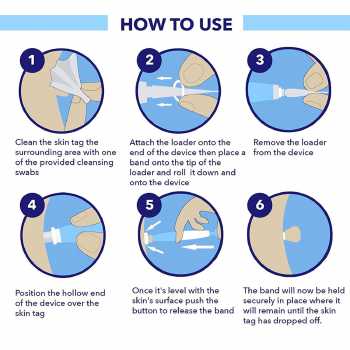 Gambar produk LEKGAVD Alat Penghilang Kutil Painless Skin Tag Mole Removal Kit - LGV40 - 4
