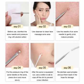 Gambar produk Biutte.co Face Care Skin Acne Pimple Needle Remover Kit 4PCS - AS1-B
