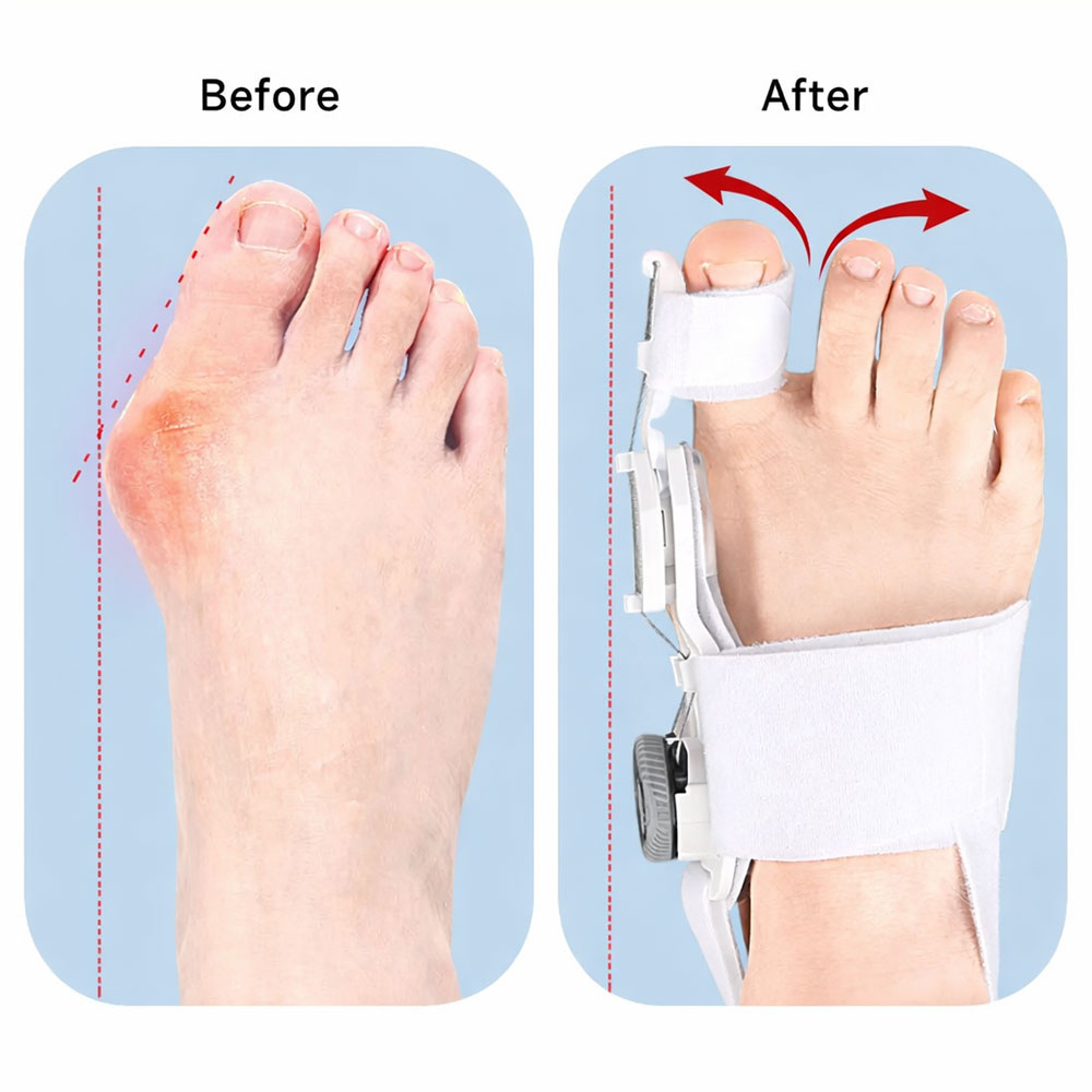 Gambar produk YOSO Korektor Pelurus Jempol Kaki Toe Separator Hallux Valgus Bunion - HF-19